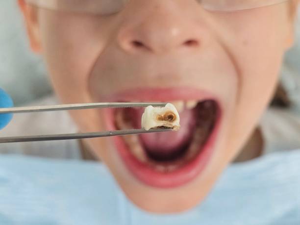 Best Emergency Treatment for Dental Infections or Abscesses in Deale, MD